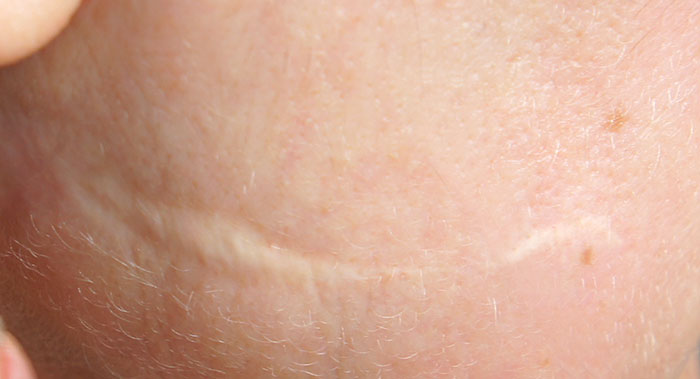 pigmentacja medyczna blizn na twarzy